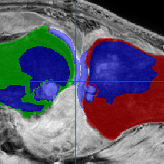 Knee joint X-ray with colour overlays.