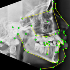 X-ray image of a skill overlaid with a point map.