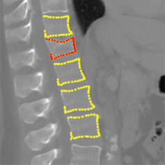 X-ray image of a spine with areas of concern highlighted.